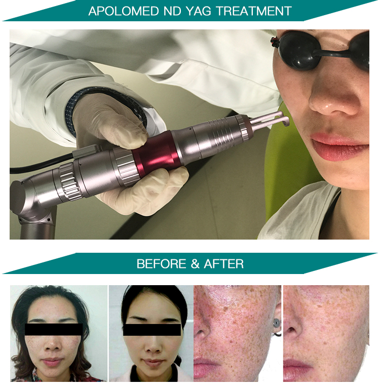 HS-298 before after photo HS-298 قبل از عکس بعد