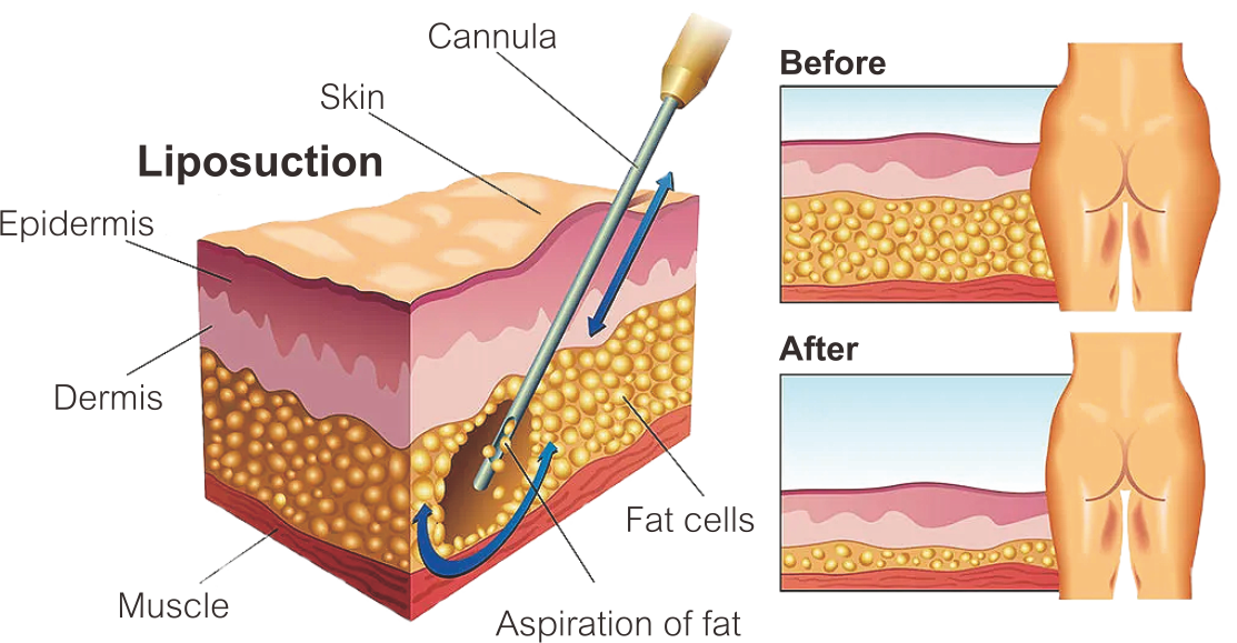 Laser Lipolysis هندپیس