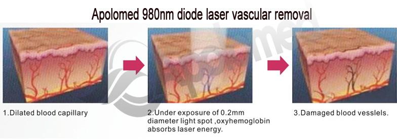 980nm diode laser vascular لیزر دایود عروقی 980 نانومتری