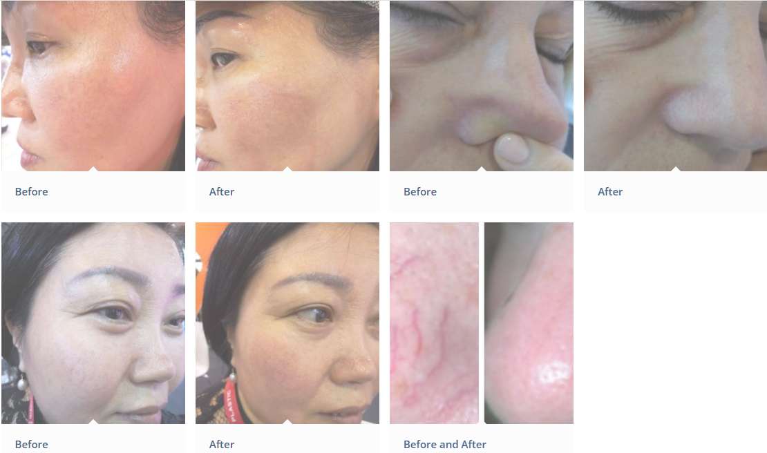 Before after photo عکس قبل از بعد