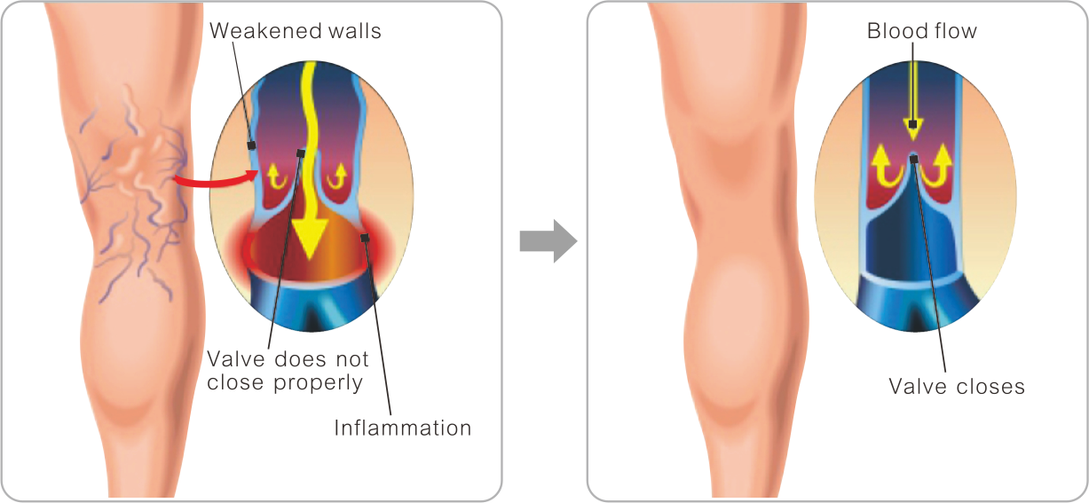 Varicose veins وریدهای واریسی