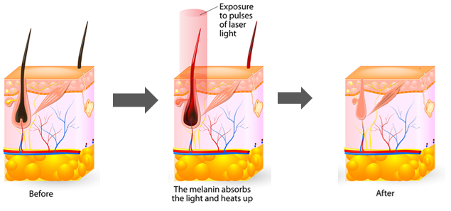 لیزر دایود 810 نانومتری برای چه مواردی استفاده می شود؟