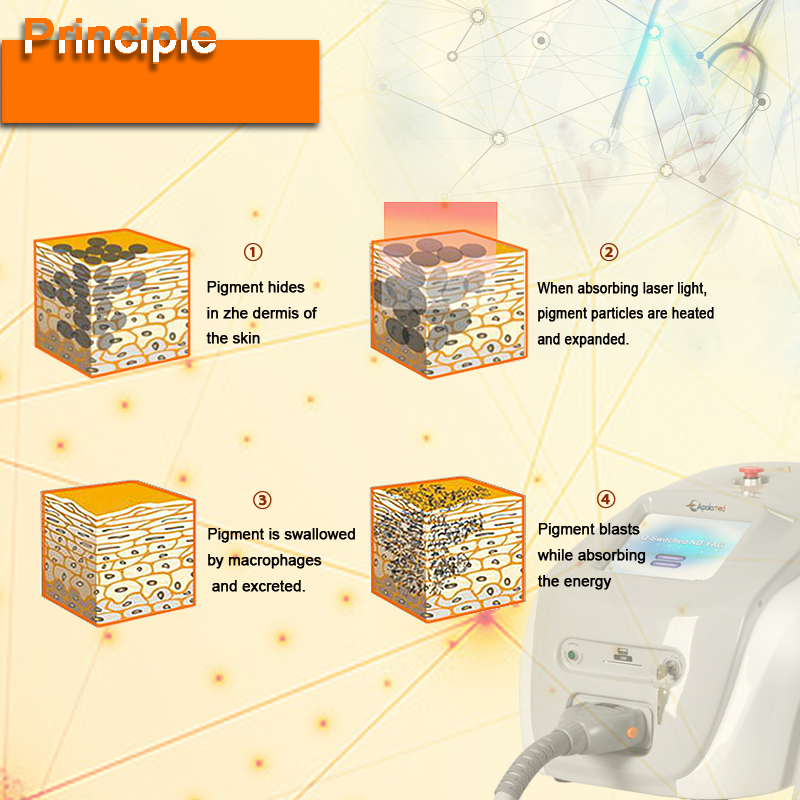 حذف خالکوبی سوئیچ q 