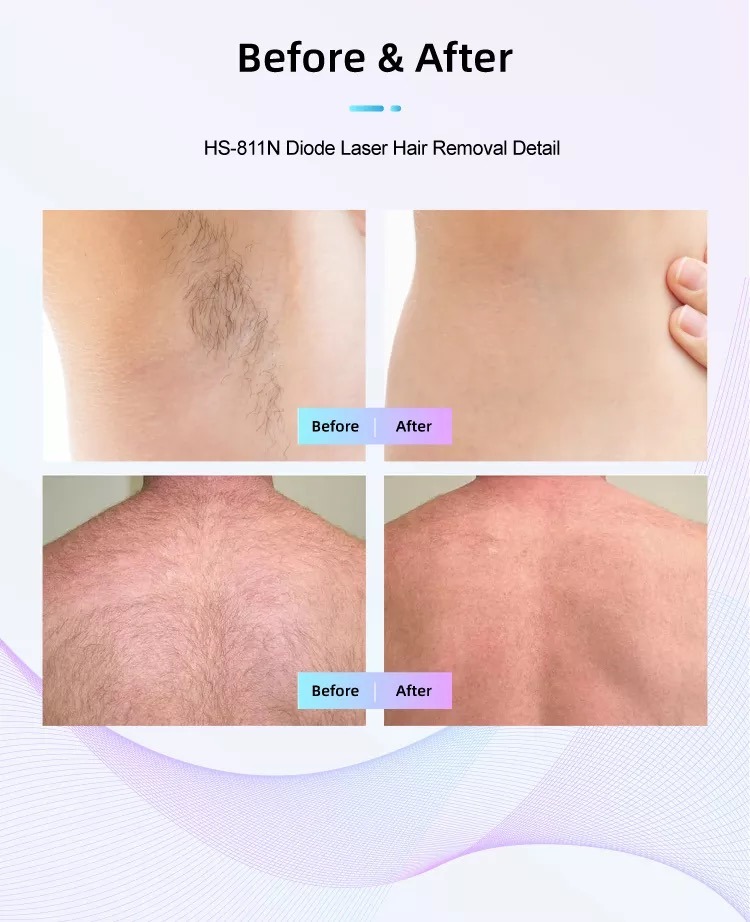 کارخانه دستگاه لیزر موهای زائد دایود HS-811
