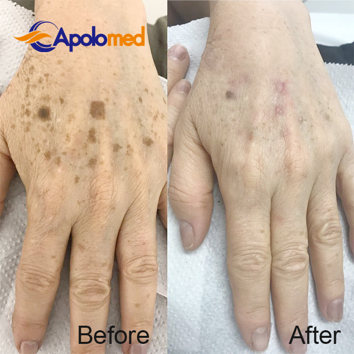 دستگاه لیزر Q-Swithced Nd YAG قبل از بعد