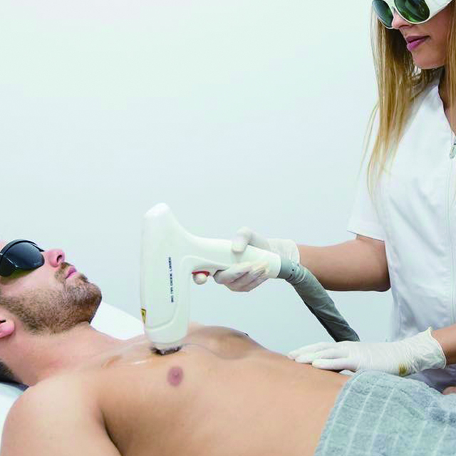 لیزر برداشتن مو