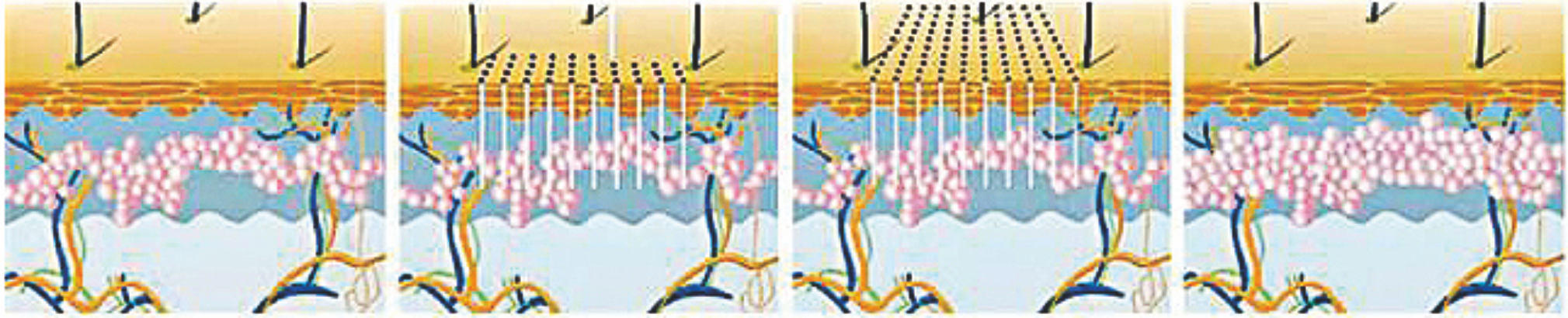 لیزر فیبر اربیوم 1550 نانومتری ---- بازسازی عمیق